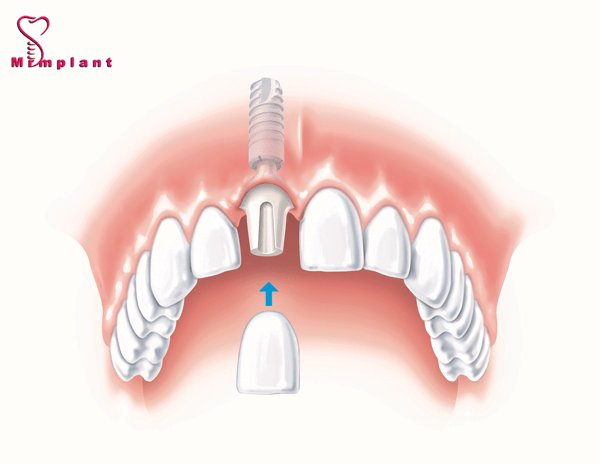 پروسه درمان کاشت ایمپلنت دندان