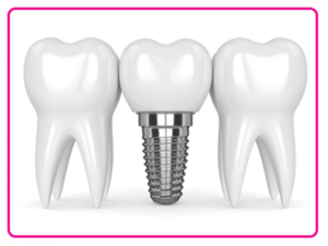 دلایل ایمپلنت دندان