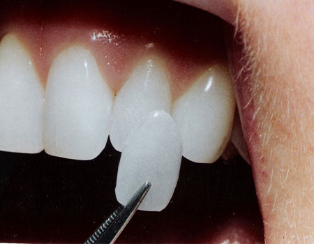 اقدامات قبل از انواع روکش دندان