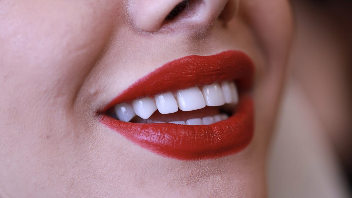 تأثیر لمینت دندان بر زیبایی خنده چیست