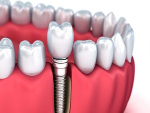 صفر تا صد مراحل ایمپلنت دندان