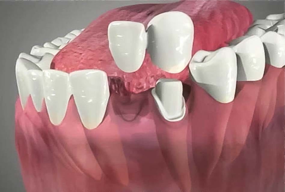 پل دندان یا بریج دندان