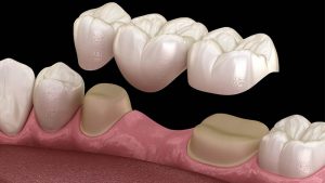 پل دندان چیست و چگونه جایگذاری می شود؟