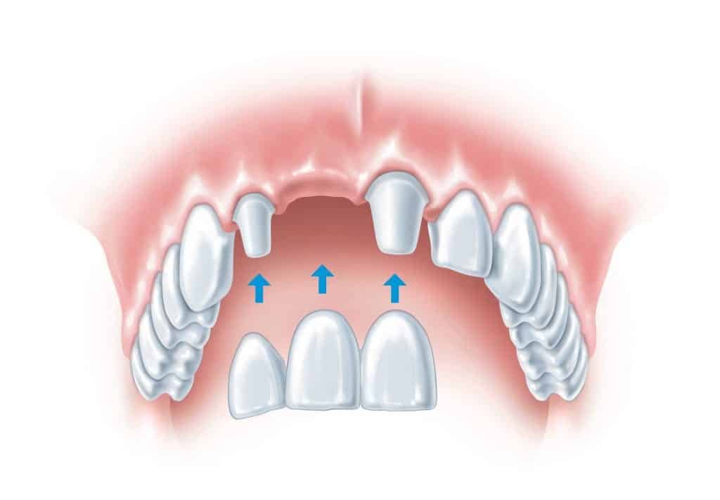 انواع پل دندان (بریج دندان)