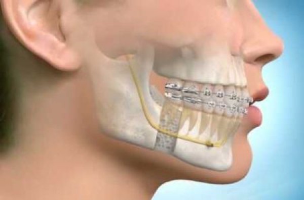 آندربایت دندان