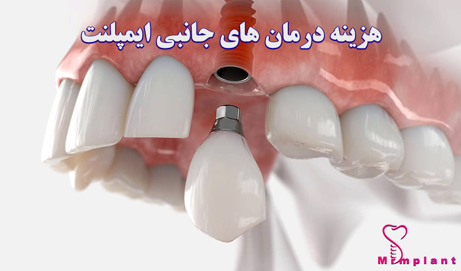 هزینه درمان های جانبی ایمپلنت دندان