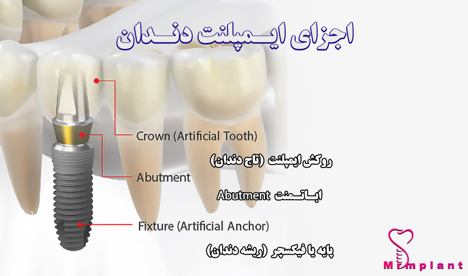 عکس اجزای ایمپلنت دندان
