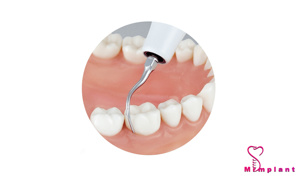 نکات مهم برای کاشت ایمپلنت دندان​
