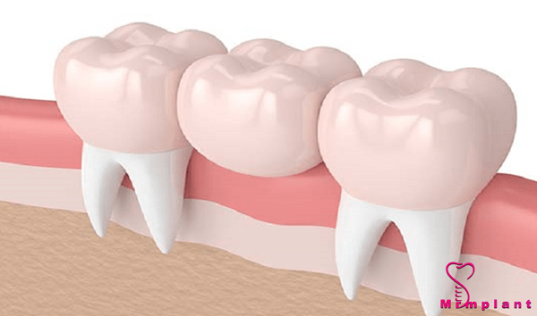 مزایای روش کاشت دندان بدون ایمپلنت بریج