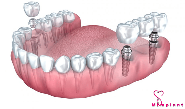 مراحل ایمپلنت دندان فوری