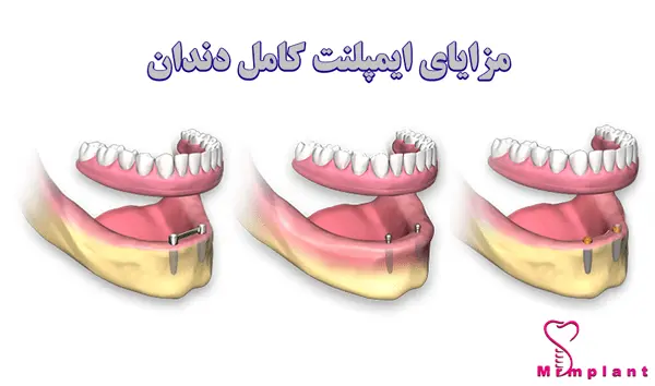 مزایای ایمپلنت کامل دندان
